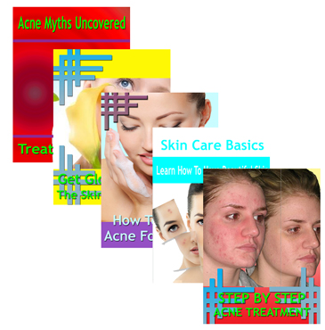 Thumbnail Beating Acne 5 Guides Collection eBook